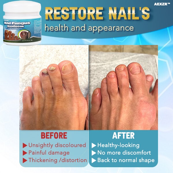 Aexzr™ 5X Quick-healing Nail Fungus Ointment