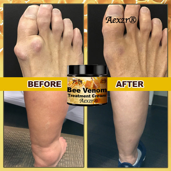 Aexzr® Arthritis Treatment Bee Venom Cream